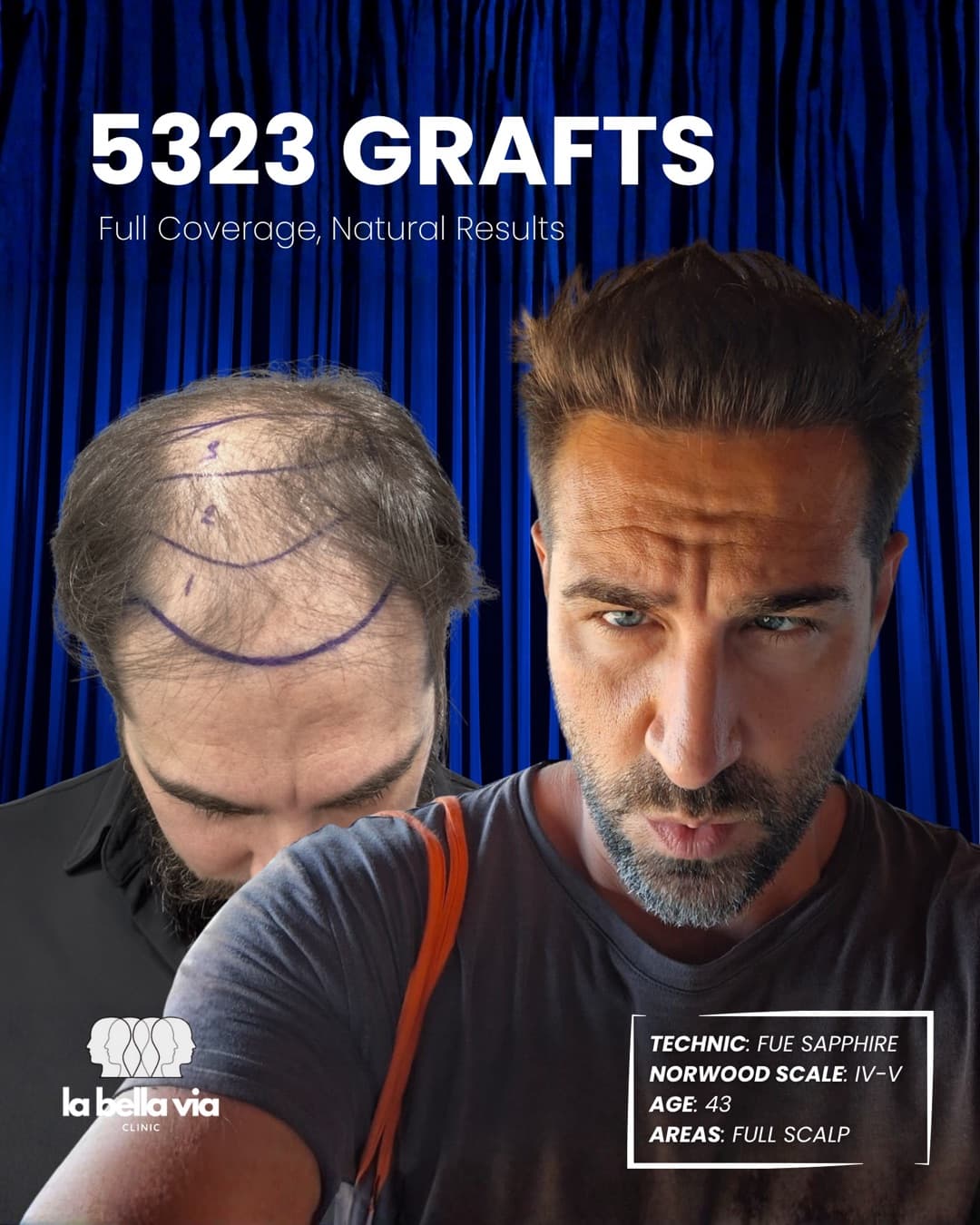 5.323 graft · Cuoio capelluto completo · uomo, 43 anni