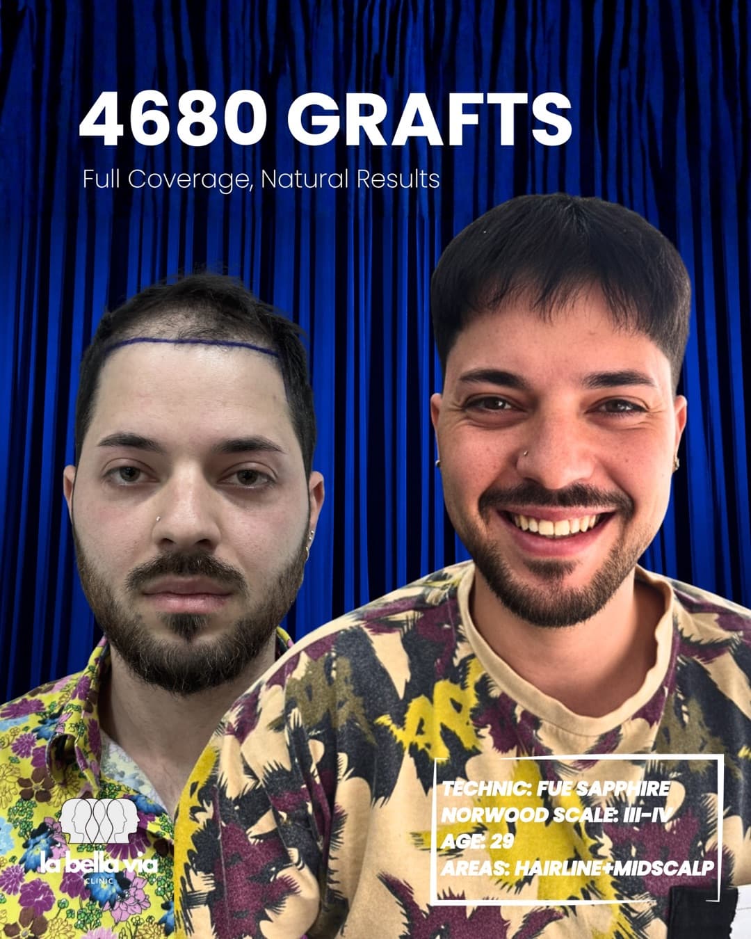 4.680 graft · Linea frontale + mid-scalp · uomo, 29 anni