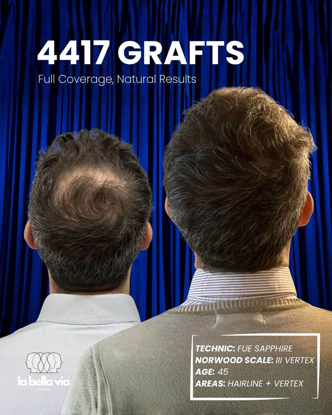 4.417 graft · Linea frontale + vertice · uomo, 45 anni