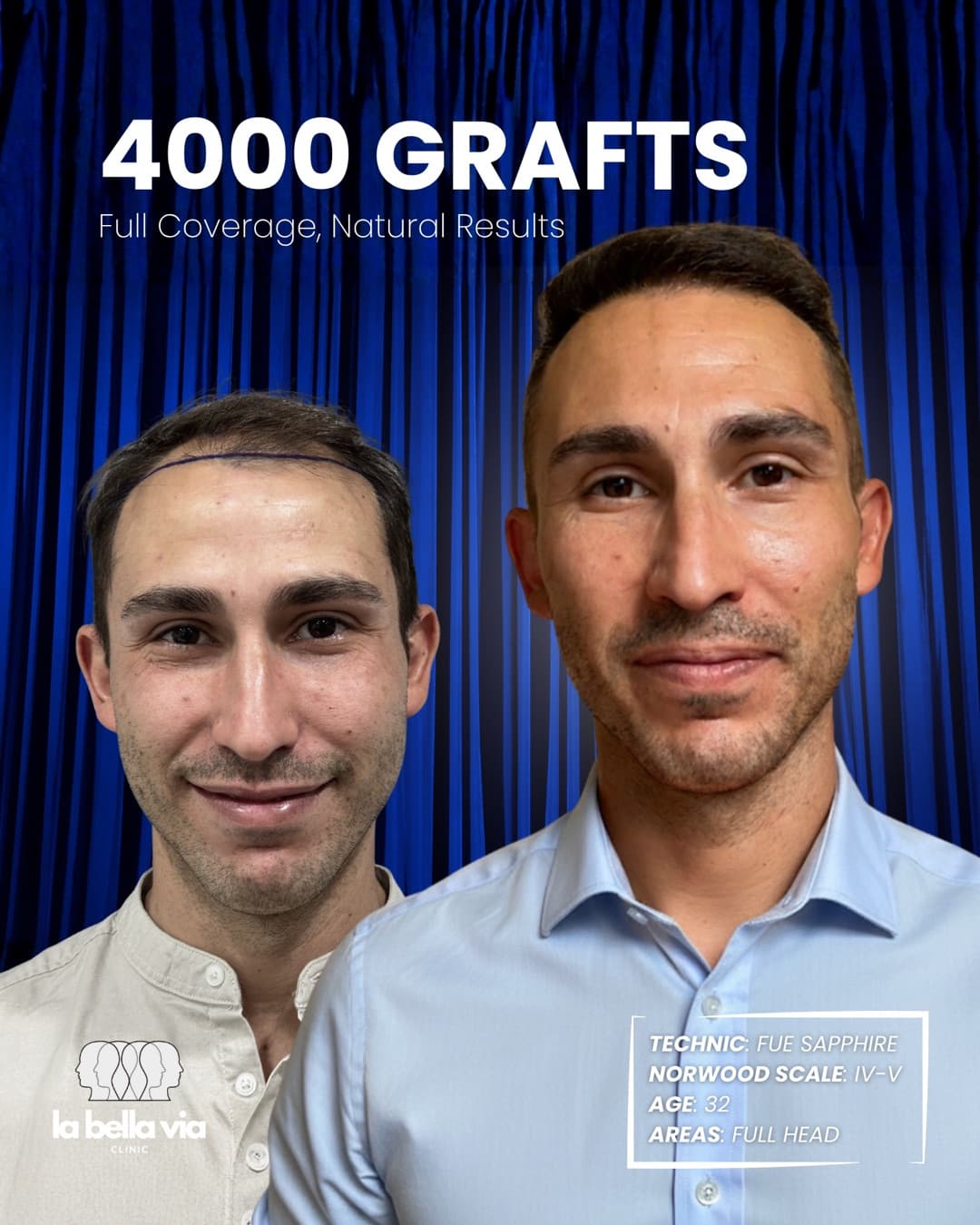 4.000 graft · Testa intera · uomo, 32 anni