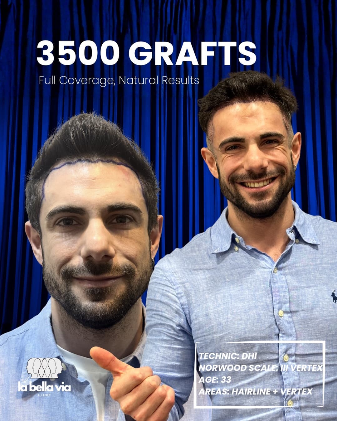 3.500 graft · Linea frontale + vertice · uomo, 33 anni
