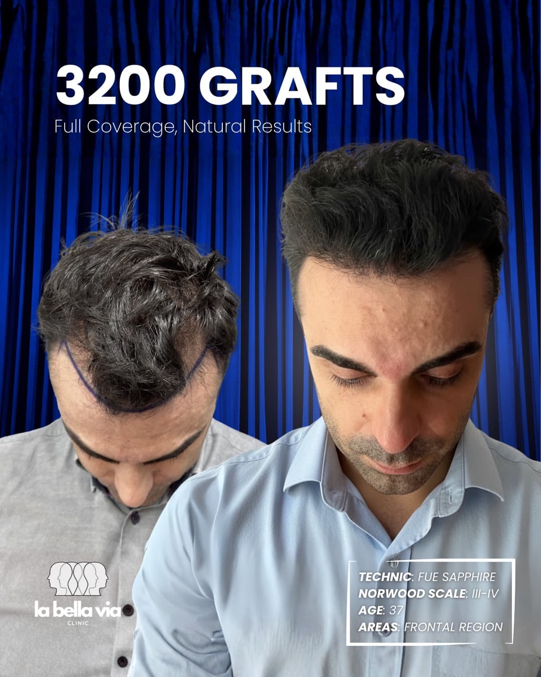 3.200 graft · Regione frontale · uomo, 37 anni